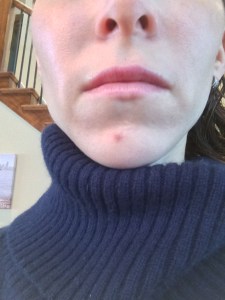 24 hours after an emergency kenalog session. No makeup.